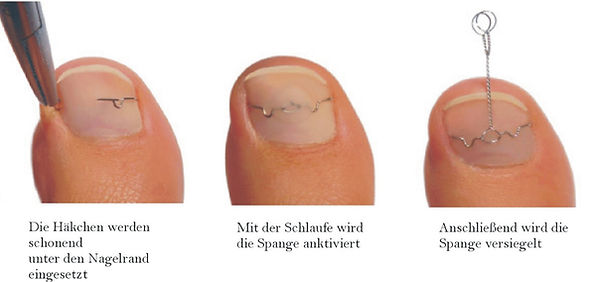 fusskundig-nagelkorrektur